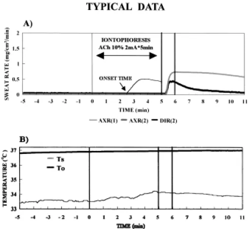 Fig 1. Typical recording of the AXR(1), AXR(2) and DIR sweating (upper panel) and of oral and skin temperatures (lower panel) in a Malaysian native subjects (M-M)