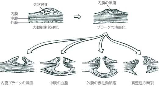 図 60  PAU（穿通性動脈硬化性潰瘍）の進展様式