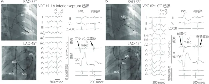 図 15  CPVT に対するカテーテルアブレーション （Kaneshiro T, et al. 2012  377) より）III III aV RaVLaVFV1V2V3V4V5V6 I II IIIaV RaVLaVFV1V2V3V4V5V6ABIIV2ヒス束プルキンエ電位冠静脈洞遠位アブレーション－18 msec双極単極 冠静脈洞遠位アブレーション 双極単極“QS”300 msec200 msecRAO 35°LAO 45°ペースマップPVC洞調律VPC #1: LV inferior septum