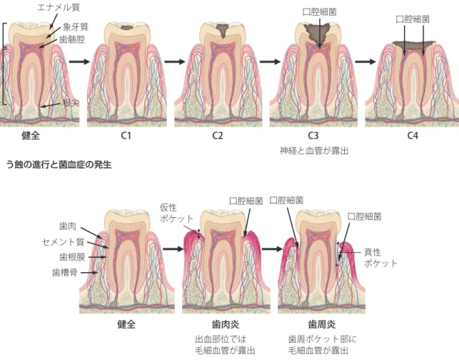図 4 う蝕の進行と菌血症の発生健全 C1 C2 C3 C4歯冠歯根エナメル質象牙質歯髄腔 口腔細菌神経と血管が露出口腔細菌根尖 健全 歯肉炎 歯周炎歯肉セメント質歯根膜歯槽骨口腔細菌 口腔細菌 口腔細菌 出血部位では 毛細血管が露出 歯周ポケット部に毛細血管が露出 図 5 歯周病の進行と菌血症の発生 真性 ポケット仮性ポケット の原因菌が血液中に入る環境が整うことになる．原因菌 のうち口腔由来のものとしては，口腔レンサ球菌種がほ とんどであるとされている 286, 287 ） ．主要な細菌として，