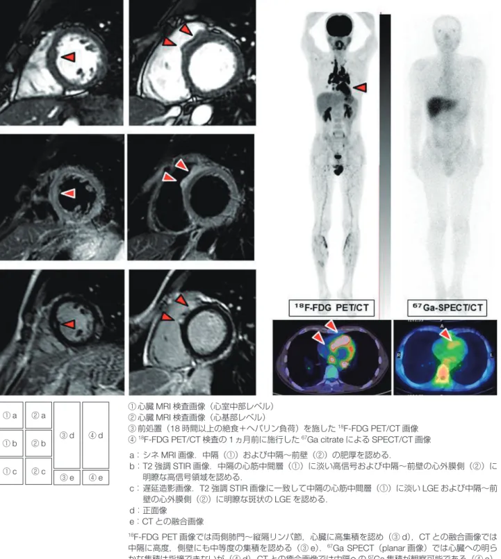 図 28  30 歳台男性，全身サルコイドーシス（臨床診断群：縦隔＋眼＋心臓）の MRI,  18 F-FDG PET および 67 Ga SPECT 画像