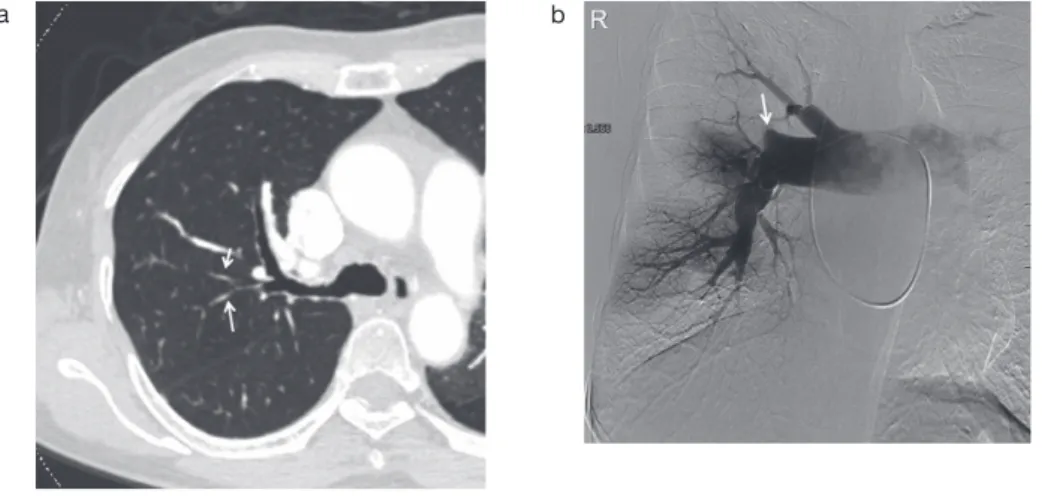 図 1 完全閉塞病変の血管像 a ：造影 CT では，右後上葉動脈（ A2 ）分枝遠位側の高度な先細り（矢印）を認める． b ：血管造影では A2 の辺縁鈍な血管の途絶像（矢印； pouching defects ）を認める．ab 図 2 部分閉塞病変の血管像：band a ：下幹本幹に，血管に両端を固定され線状の構造をした band （矢印）を認める． b ：血管造影では band は線状の欠損像（矢印）として認める．ab a b 図 3 部分閉塞病変の血管像：web
