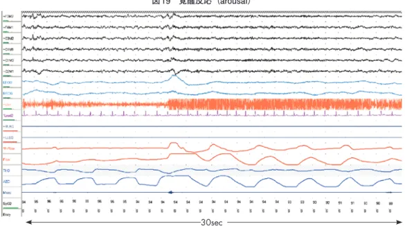 図 19　覚醒反応（arousal） 30sec 脳波周波数のα，θ，紡錘波を除く周波数 16Hz以上の速波への突然の変化である．最低3秒以上持続し，その前には最低10秒以上 の睡眠がなければならない．occipital，central 両誘導にて判定する． 図 20　無呼吸（apnea） A　中枢性無呼吸（Central apnea） B　閉塞性無呼吸（Obstractive apnea） C　混合性無呼吸（Mixed apnea） 2 min2 min 2 min吸気努力が消失している．吸気努力を認める