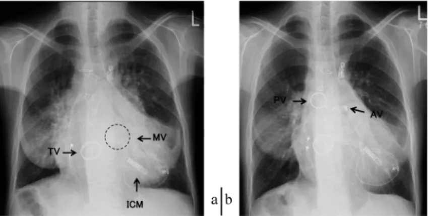 Fig.   2   Preoperative MDCT (volume rendering image)