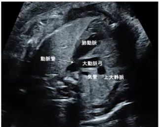 図 11  右室流出路図10 左室流出路図9  Three-vessel view