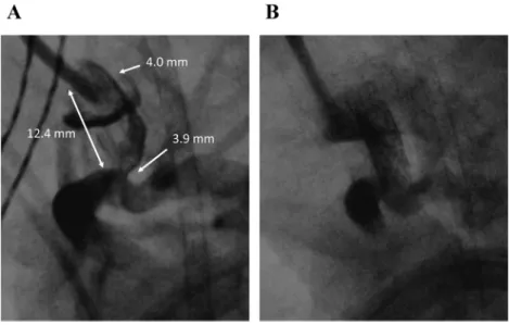 Fig.   3   Case 2: DS for DORV/PA, 18 trisomy