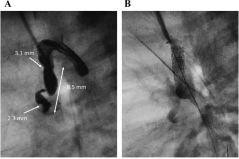 Fig.   5   Case 3: Chest X-ray and four chamber view of two-dimensional transthoracic echocardiography