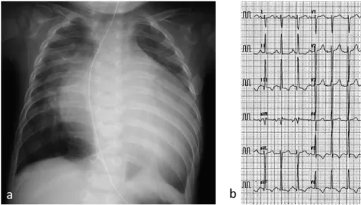 Table   1   Intraoperative hemodynamic measurements during pulmonary artery banding