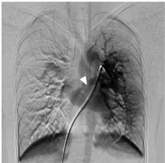 Fig.   4  Right pulmonary arteriography levophase  (DSA)