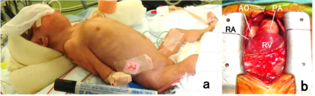 Fig.   4   A newborn patient with trisomy 18
