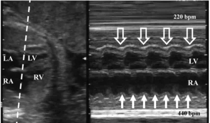 Fig.   2  Fetal echocardiographic Doppler wave form of the simultaneous record of the superior vena cava  (SVC) and the ascending aorta (aAo)