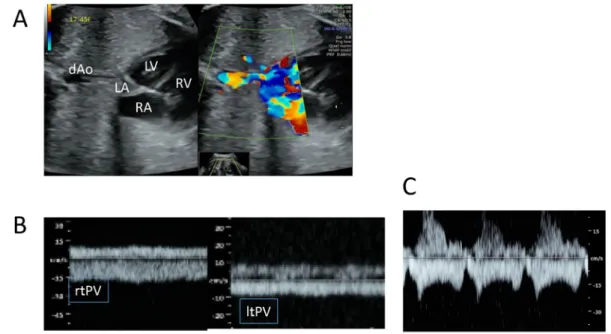 Fig.   8   Hypoplastic left heart syndrome