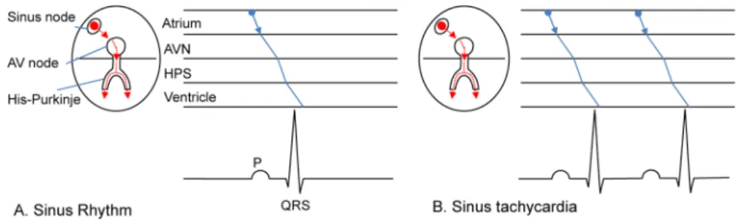 Fig.   2   Accessory pathway and atrioventricular reciprocating tachycardia