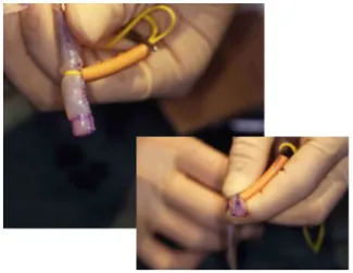 Fig.   4   Norwood procedure using the RV-PA conduit