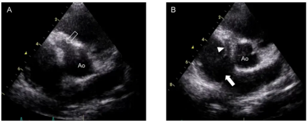 Fig.   2   Aortography frontal view (A) and lateral view (B)