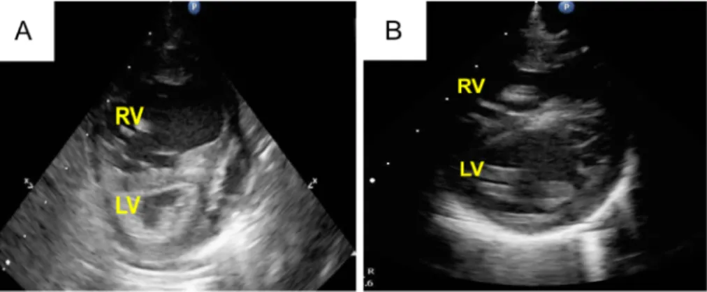 Fig.   2   Preopetrative (A) and postoperative(B) echocardiography in case 1