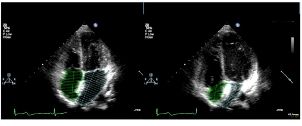 Fig.   1   Tow-dimensional echocardiograms from apical four-chamber