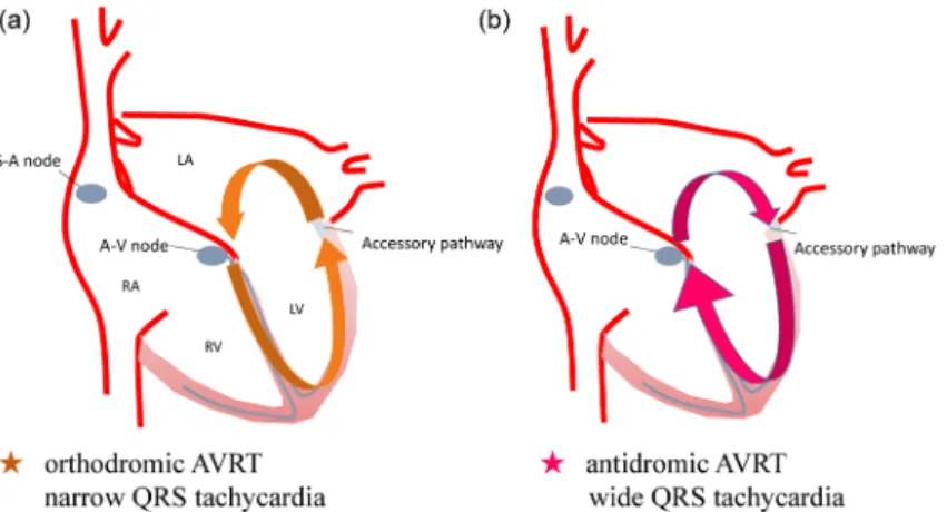 Fig.   3   ECG of atrial ﬁbrillation with WPW syndrome