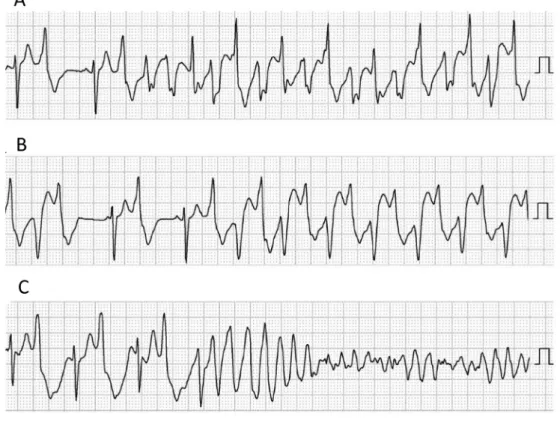 Fig.   1   Typical features of ventricular tachycardia in a patient with CPVT