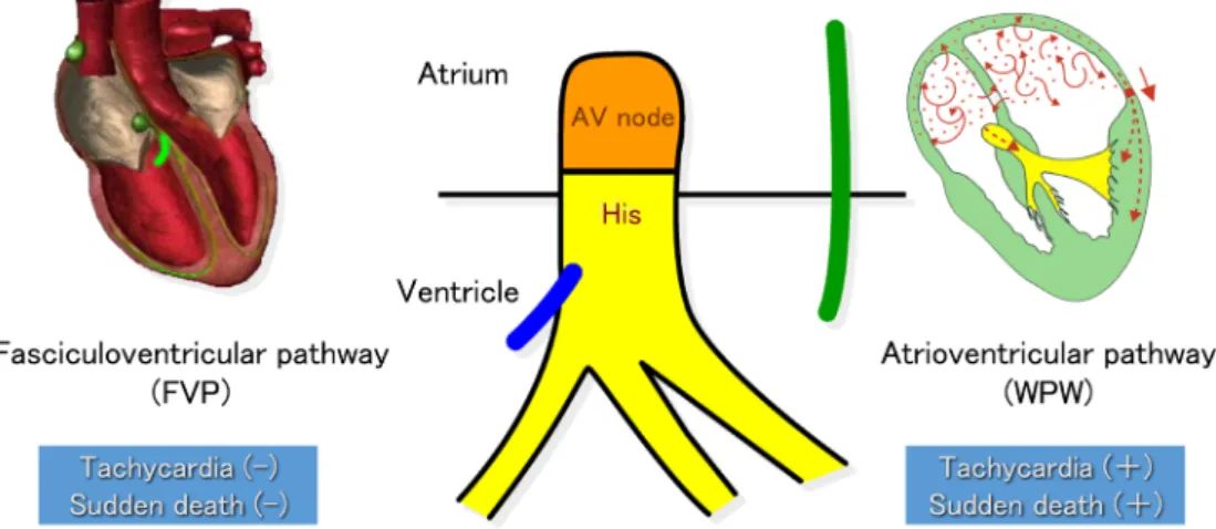 Fig.   4   A schematic diagram showing accessory pathway localization in WPW and FVP