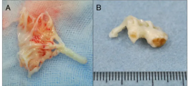 Fig.   2   Congenital mitral stenosis