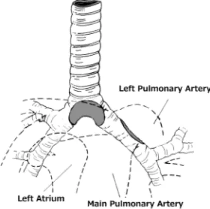 Fig.   1  A drawing of typical tracheal and bronchial compression