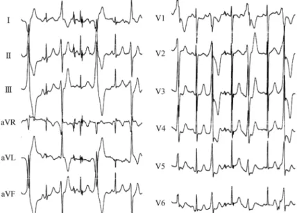 Fig.   1  One week after orally administering carvedilol, exercise electrocardiography using the Bruce proto- proto-col revealed polyphasic premature ventricular contraction during stage I