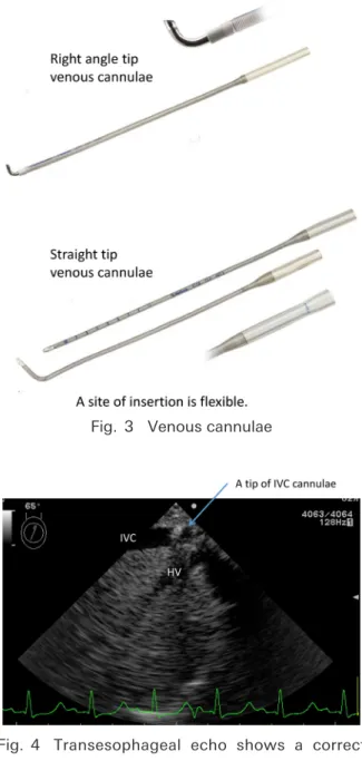 Fig.   4  Transesophageal echo shows a correct  position of the tip of a venous cannula