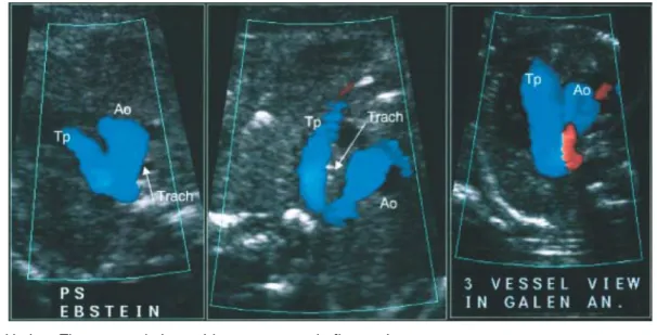 Fig.   4   U-sign: Three-vessel view with two antegrade ﬂow stripes