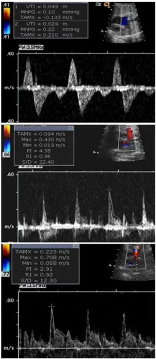 Fig.   6   Pulmonary venous Doppler ﬂow patterns  and maternal hyperoxygenation testing