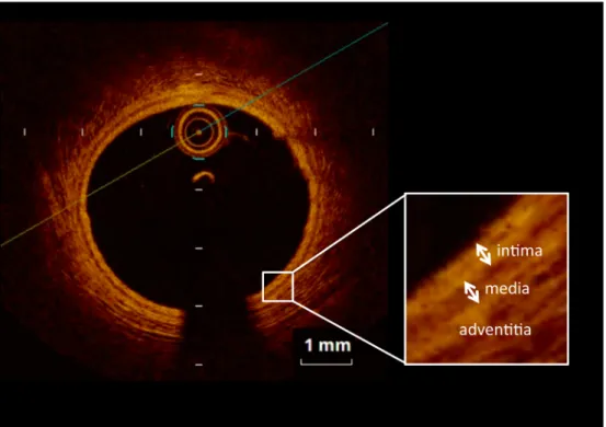 Fig.   4   Optical coherence tomography imaging of normal coronary artery (Case 3, segment 11)