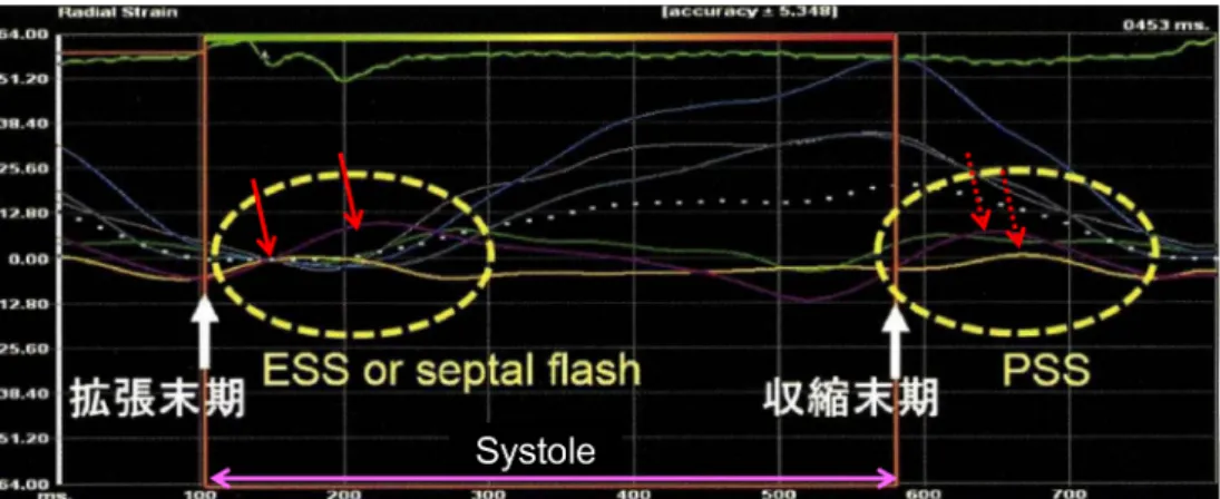Fig.   8   The typical dyssynchrony pattern in the radial strain by speckle tracking with a septal ﬂash and post  systolic shortening (PSS) in a dilated cardiomyopathy patient with a complete left bundle-branch  block