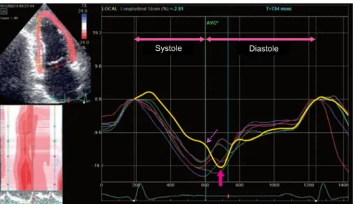 Fig.   9   A typical dyssynchrony pattern with post systolic shortening (PSS) in a longitudinal strain by  speckle tracking