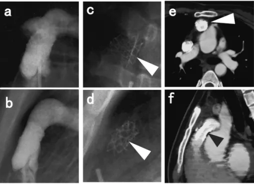 Fig.   6   Fracture of the stent in MPA