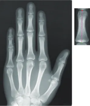 Fig. 1. Anteroposterior X-ray image of the hand  (left) and enlargement of the MP3 part (right)  showing two digitized points connected by a  line segment representing the MP3 length.