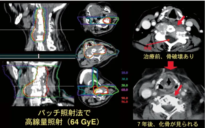 図 I-1-7 は、重粒子線治療が有効であった典型例であ る。なお、 脳腫瘍や膵癌など超難治がんなどにおいては、 それなりの成績向上が得られているものの、まだ満足で きるものではなく、さらに改善を目指して臨床試験を続 けている。 4.重粒子線治療の意義 レントゲンにより X 線発見が報告されたのは 1895 年 12 月のことであるが、翌年 1 月にはすでに X 線治療が 始められた。それ以来、放射線治療において最大の課題 は病巣への線量集中性の改善であるが、その重要性は、 1950 年代以降に常圧エネルギ