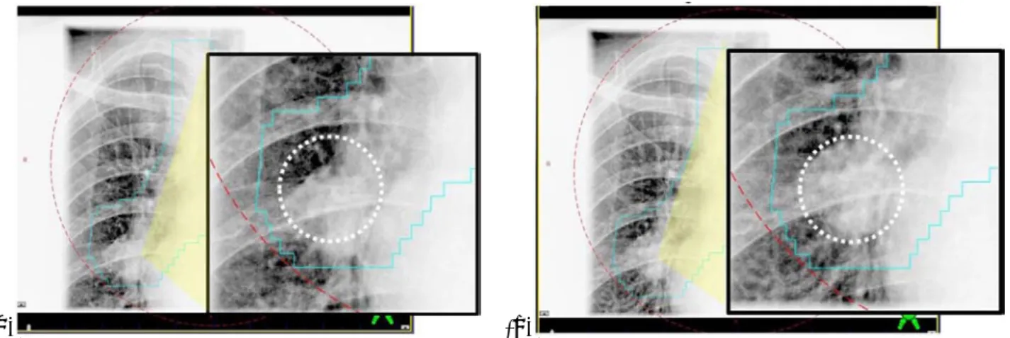 Figure 6    OBI を用いた 2D matching (a)自由呼吸下 kV 画像, (b)RPM を用いた呼吸同期下 kV 画像. 