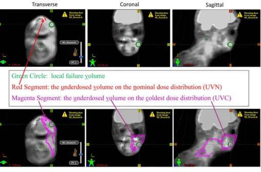Illustration of the PET/CT fused with the planning CT for one patient: (a) association between the underdosed  volume in the nominal dose distribution (UVN) and local failure; (b) association between the underdosed volume in  the coldest dose distribution 