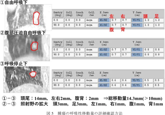 図 5  腫瘍の呼吸性移動量の詳細確認方法  3．治療計画 CT 撮像方法  当院で呼吸性移動が問題になる部位に対して実施している CT 撮像方法は，同一スライス位置 で Fast-Scan を連続複数回，それぞれのスライス位置で 1.0 秒スキャン×6 回を基本とし，呼吸周 期が長い，もしくは呼吸が安定しない場合には 1 秒スキャン×10 回や 0.5 秒スキャン×12 回とす るなど，個々の症例でスキャン時間と回数を変更している．それぞれのスライス位置ごとで得ら れた画像はそれぞれのスライス位置ごとに平