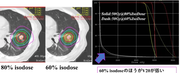 図 13  80%Isodose 処方と 60%Isodose 処方の比較