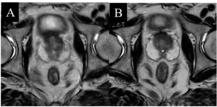 Fig. 2. Improvment of the motion artifact by the difference  in breathing style. 