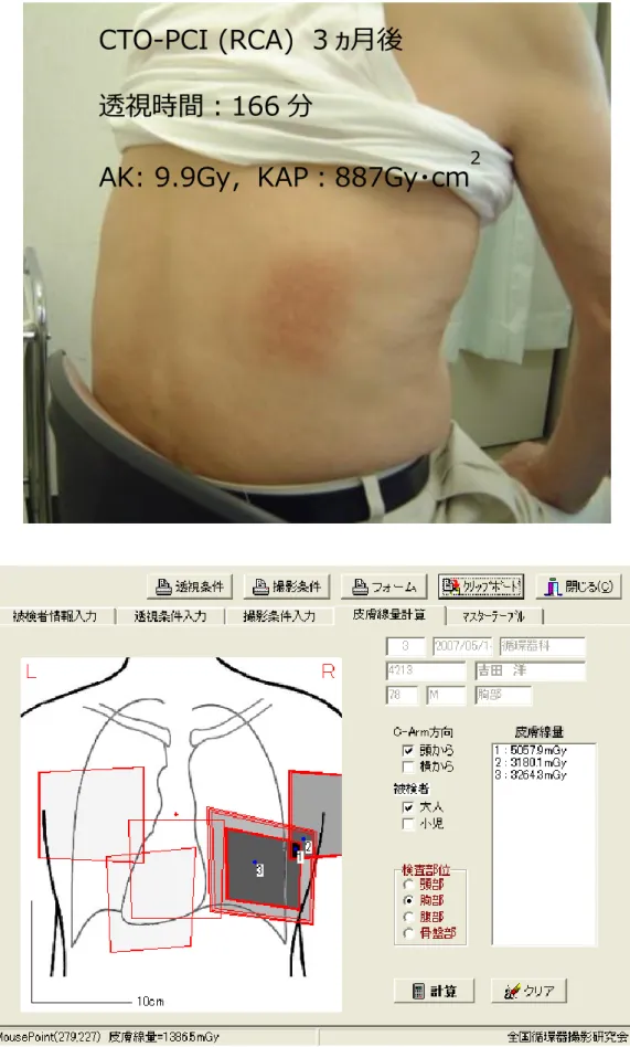 図 4  皮膚障害の 2 症例目