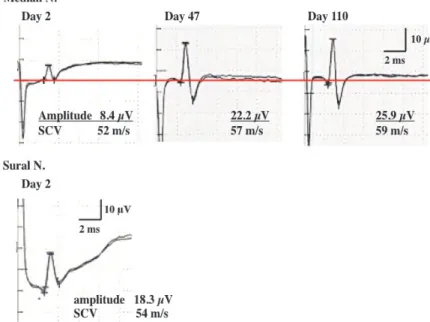 Fig. 1. Sensory nerve conduction study ﬁndings in Patient 1. (Upper) SCS in the median nerve on  Days 2, 47 and 110
