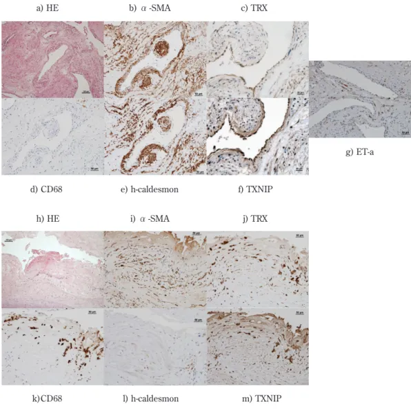 図 2   PEA 検体における Endothlin-1 の mRNA 発現                                      Δ CT 法a) HEb) α -SMA c) TRXd) CD68e) h-caldesmonl) h-caldesmon f) TXNIP g) ET-ah) HEi) α-SMAj) TRXm) TXNIPk)CD68