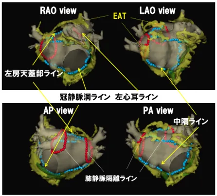 図 2 EAT−based ablation法