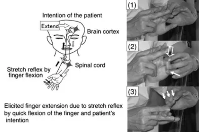 Fig. Hypothesized mechanism of a newly designed facilitation exercise for the hemiplegic upper limb and ﬁngers.