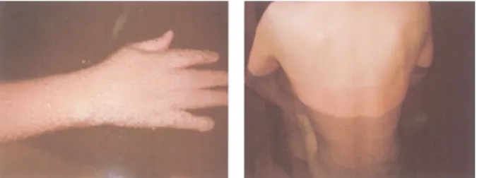 Fig. - Laser doppler imaging of cutaneous blood ﬂow of foot after CO , bathing (CO , concentration of + , *** ppm) and tap water bathing of ten minutes for a ,- year old female.