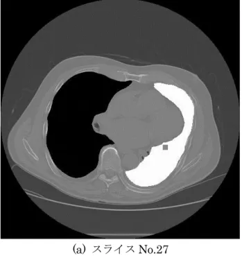 図 2-9  形状の急変による肺領域の抽出不足 