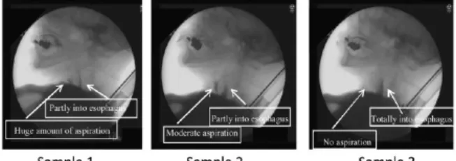Fig.  1  VF  of  a  patient  who  showed  aspiration  for  two  samples,  sample  1  (high  molar  mass  guar  solution),  sample  2  (low  molar  mass  guar  solution),  and  without  aspiration  for  sample  3  (xanthan)  26)  