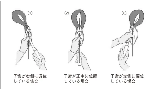 図 2-a　我々が考案した胚移植法 :ET カテーテルガイドと経腟プローブの位置関係